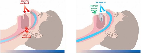 Sleep-Apnea-Mouthpiece