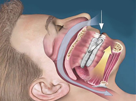 Sleep-Apnea-Mouthpiece