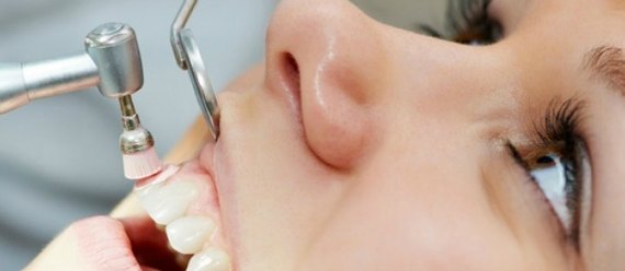 Benefits Of Teeth Polishing
